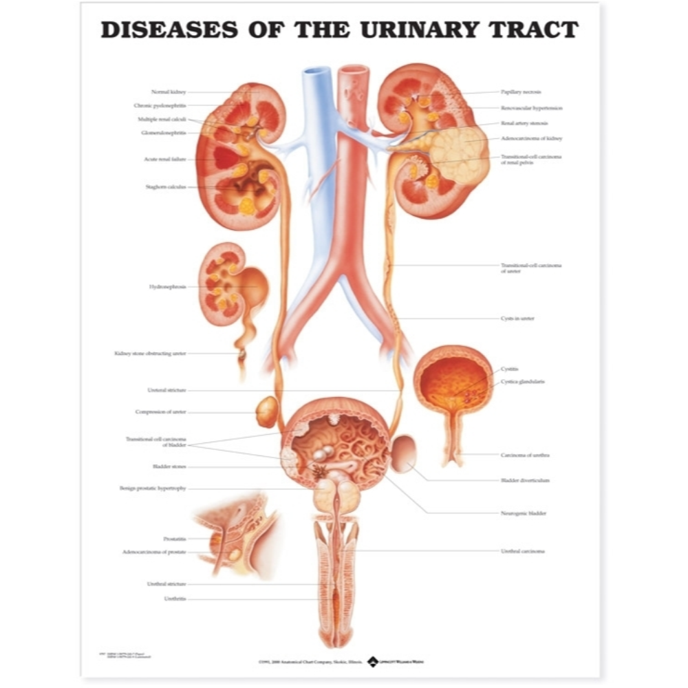 Diseases of the Urinary Tract Anatomical Chart