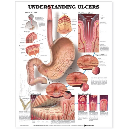 Understanding Ulcers Anatomical Chart