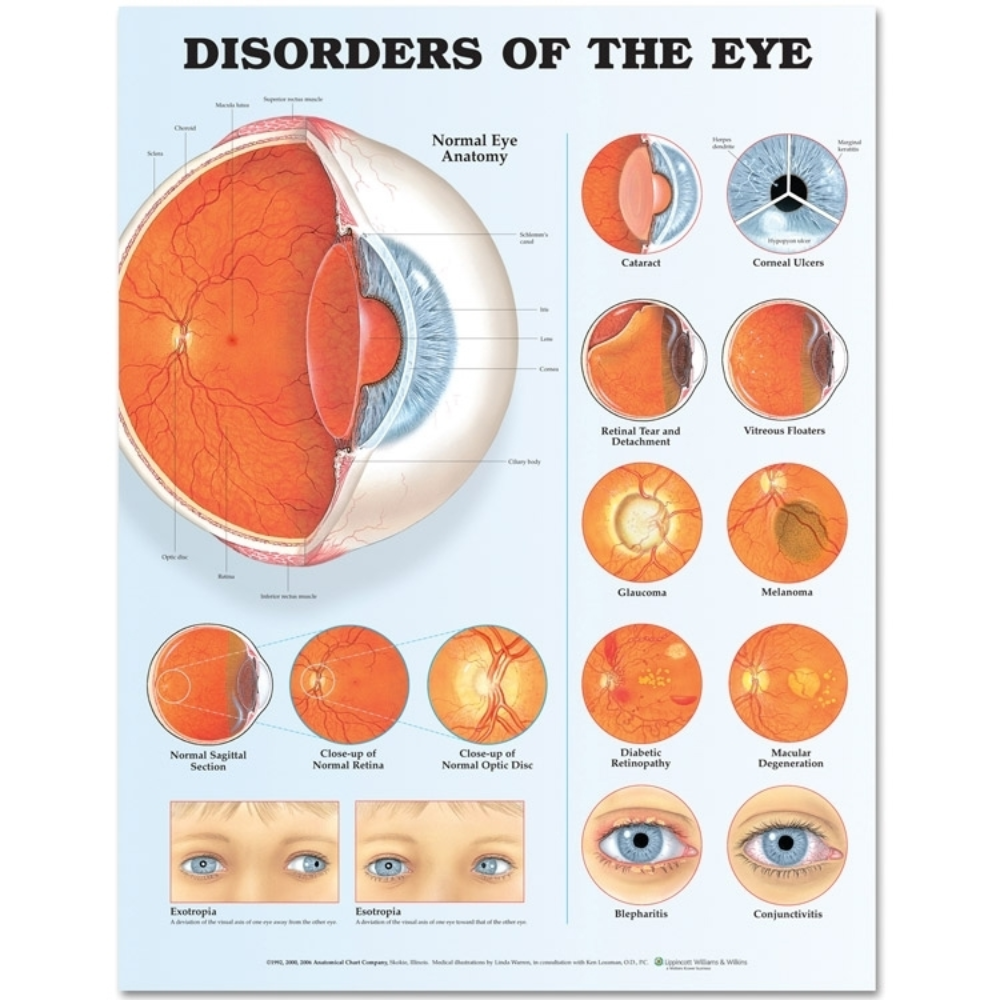 Disorders of the Eye Anatomical Chart