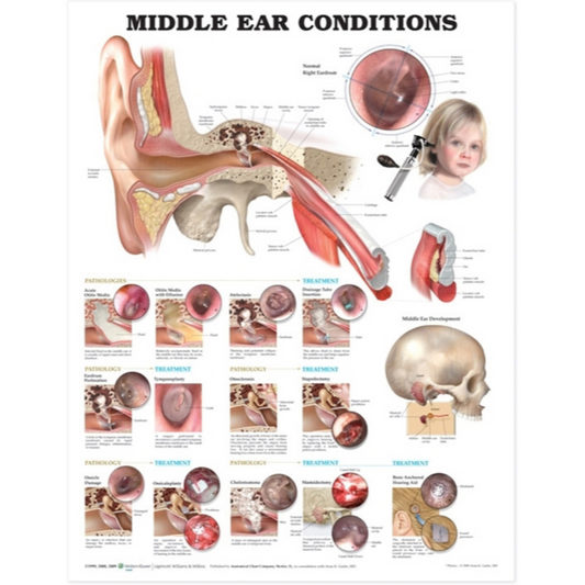 Middle Ear Conditions Anatomical Chart